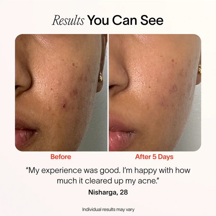 Bye Acne: 3-Minute Pimple Spot Treatment