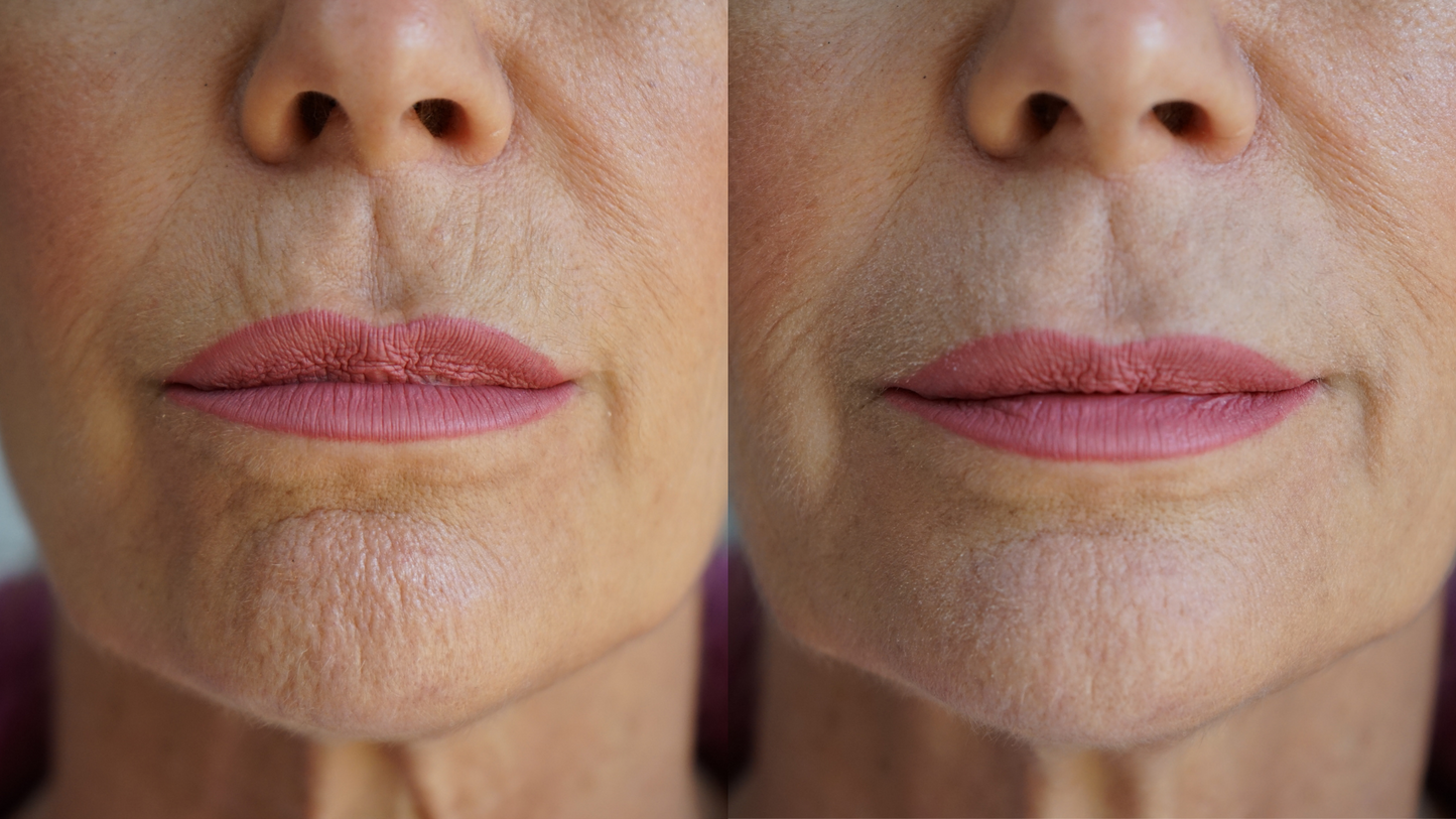 Rellenador Antiedad para Labios y Líneas
