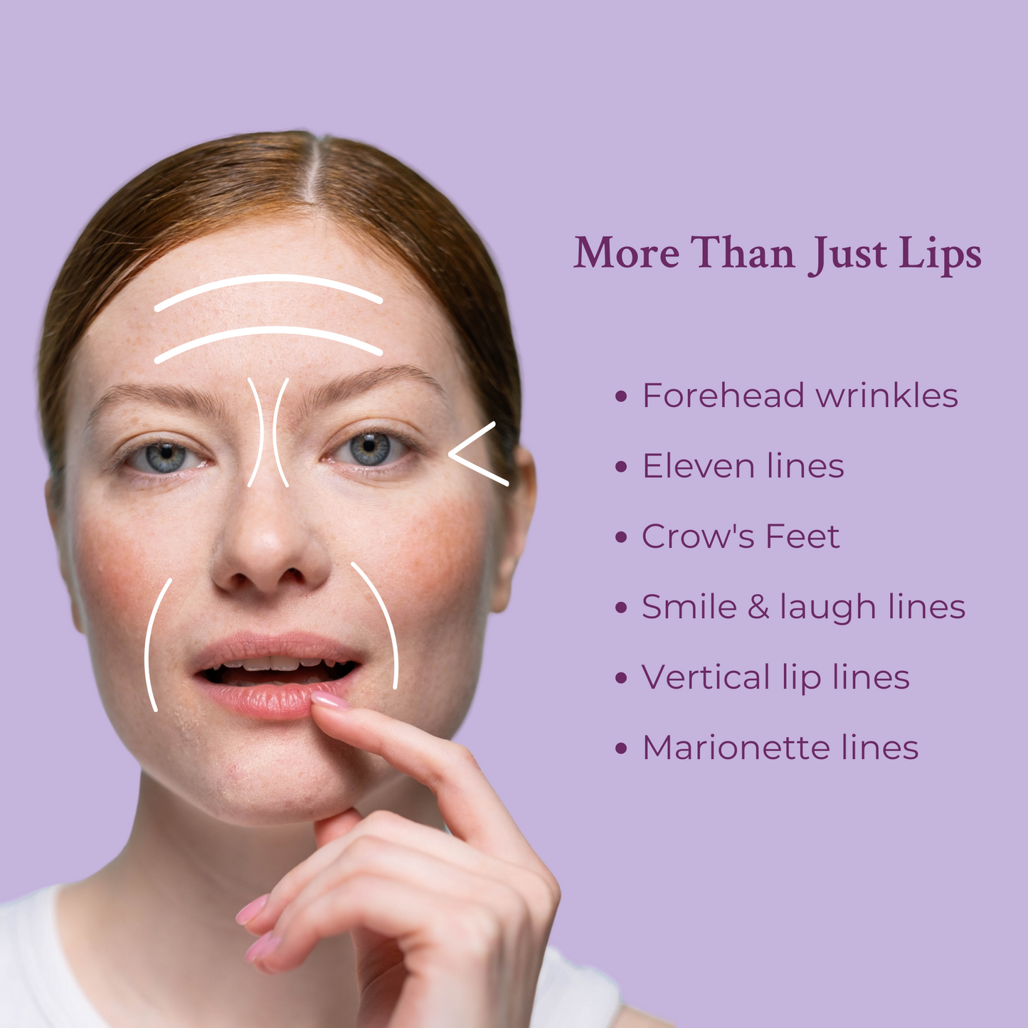 Rellenador Antiedad para Labios y Líneas