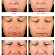 Retinoid Serum 2.5% & 5% | Advanced Anti-Aging Treatment WRI-LAX 5x