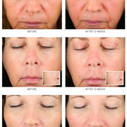 Retinoid Serum 2.5% & 5% | Advanced Anti-Aging Treatment WRI-LAX 5x