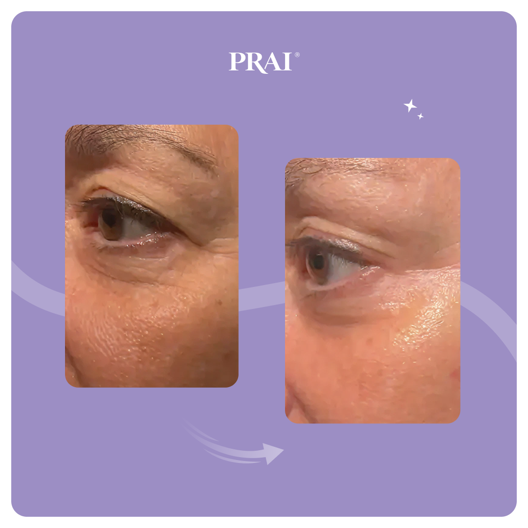 Sérum Reafirmante y Lifting para Contorno de Ojos de Efecto Duradero