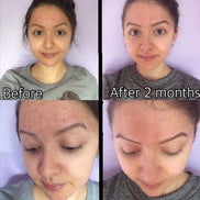 3-Step Acne System